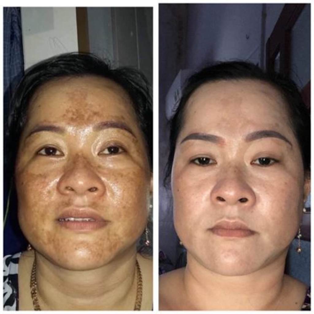 Kem dưỡng giúp làm mờ thâm nám, tàn nhang, đồi mồi White Perfect D2 Skin Power Cream