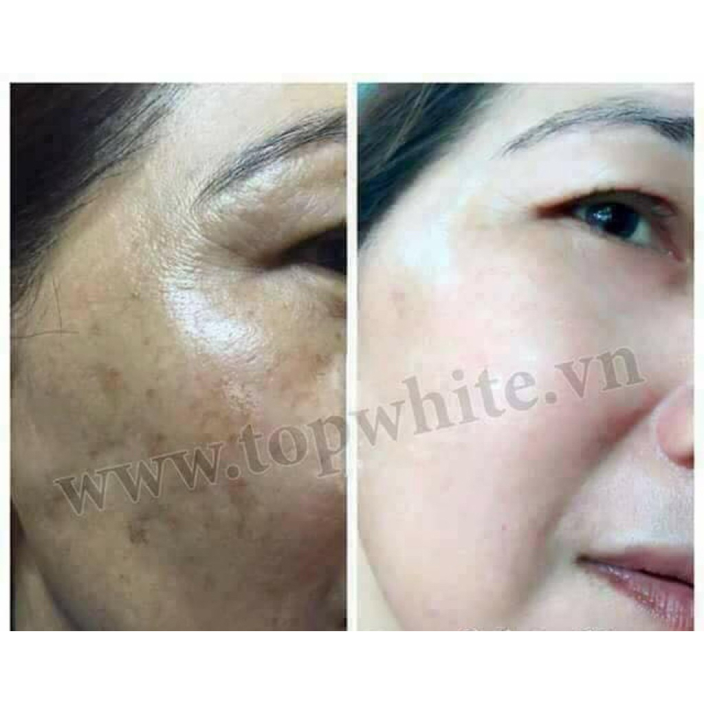 Kem dưỡng giúp làm mờ thâm nám, tàn nhang, đồi mồi White Perfect D2 Skin Power Cream