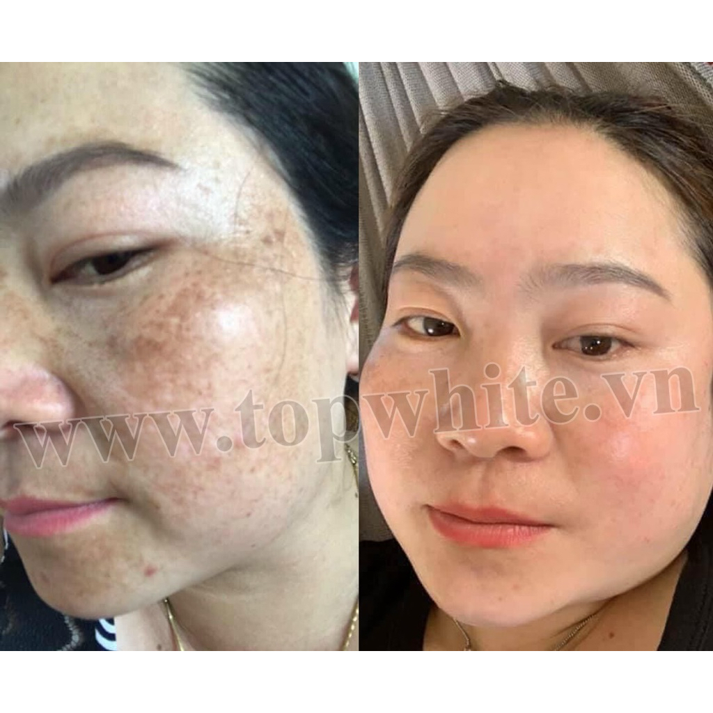 Kem dưỡng giúp làm mờ thâm nám, tàn nhang, đồi mồi White Perfect D2 Skin Power Cream