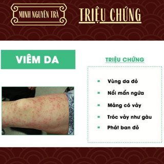 Trà Túi Lọc Thải Độc Da - Minh Nguyên - Viêm Da Cơ Địa, Chàm Da, Nấm, Ngứa, Bội Nhiễm, Vảy Nến, Á Sừng, Tổ Đỉa - 50 lọc