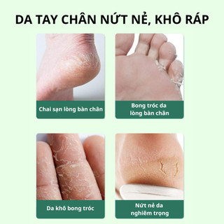 Kem nứt nẻ gót chân tay MAIGOOLE 150g - Hỗ trợ phục hồi da nứt nẻ, giảm bong tróc, khô ráp ở tay và chân