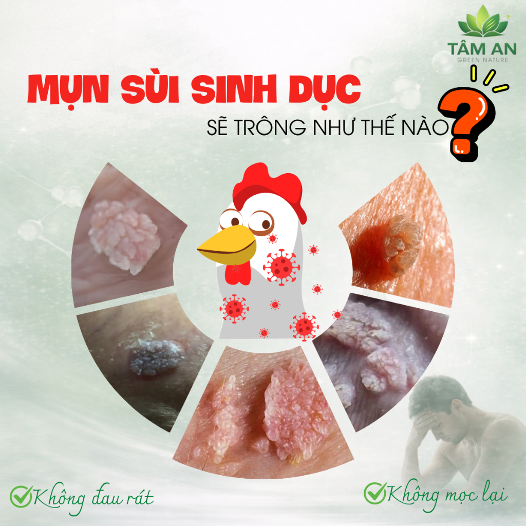 Combo Xử Lý Mụn Sùi Mào Gà Tại Nhà An Toàn, Kín Đáo [An Mộc Nhiên + THYMOKARON]