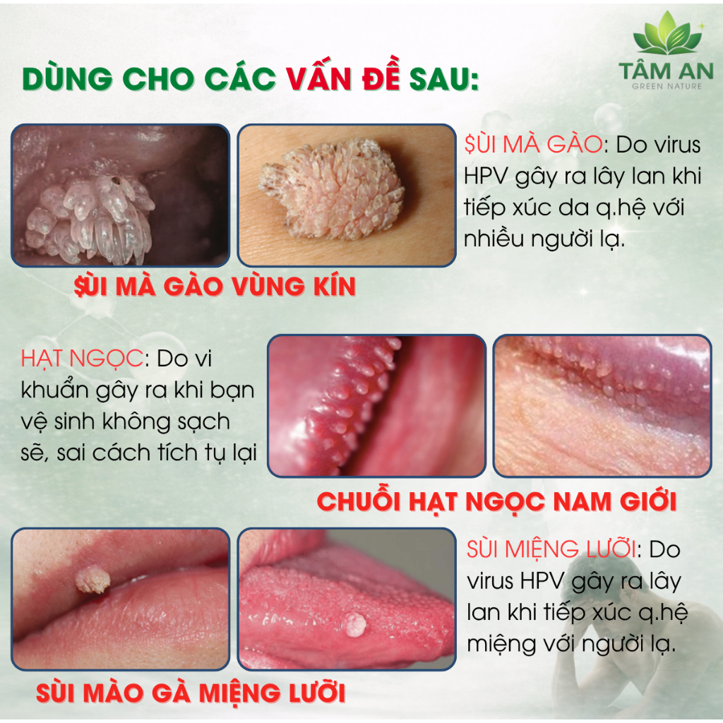 [MỤN VÙNG KÍN] Tinh Chất Hỗ Trợ Xử Lý Sùi Mào Gà, Hạt Ngọc, Mụn Li Ti 10ml (Che Tên) AMN 10ML [S]