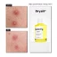 Dung Dịch Chấm Mụn Acnemy Dryzit Spot Drying Lotion 30ml giảm mụn sưng, mụn mủ, mờ thâm mụn sáng da