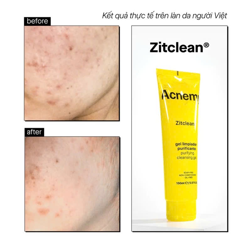 Gel Rửa Mặt Làm Sạch Cho Da Dầu Mụn Acnemy Zitclean Purifying Cleansing Gel 150ml - Skin Studio