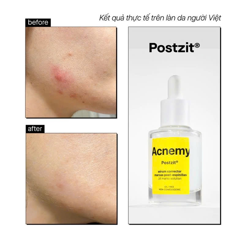 Serum mờ thâm Acnemy Postzit giảm thâm ngừa mụn tái phát POSTZIT POST BREAKOUT TREATMENT 30ml