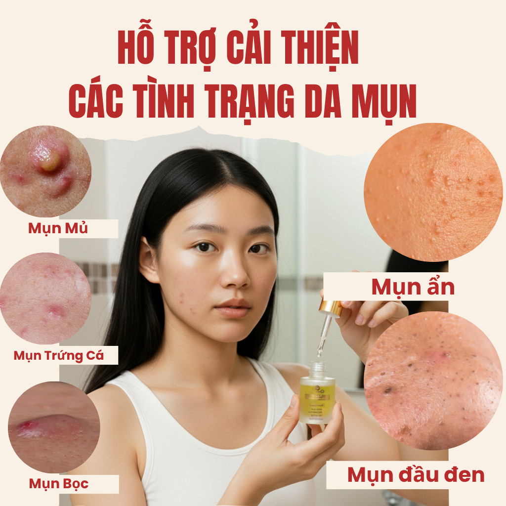 Serum hỗ trợ Giảm Mụn Ẩn ,Mụn Đầu Đen ,Mụn Thâm Cho Da Dầu Doctor care Acnes Elimination