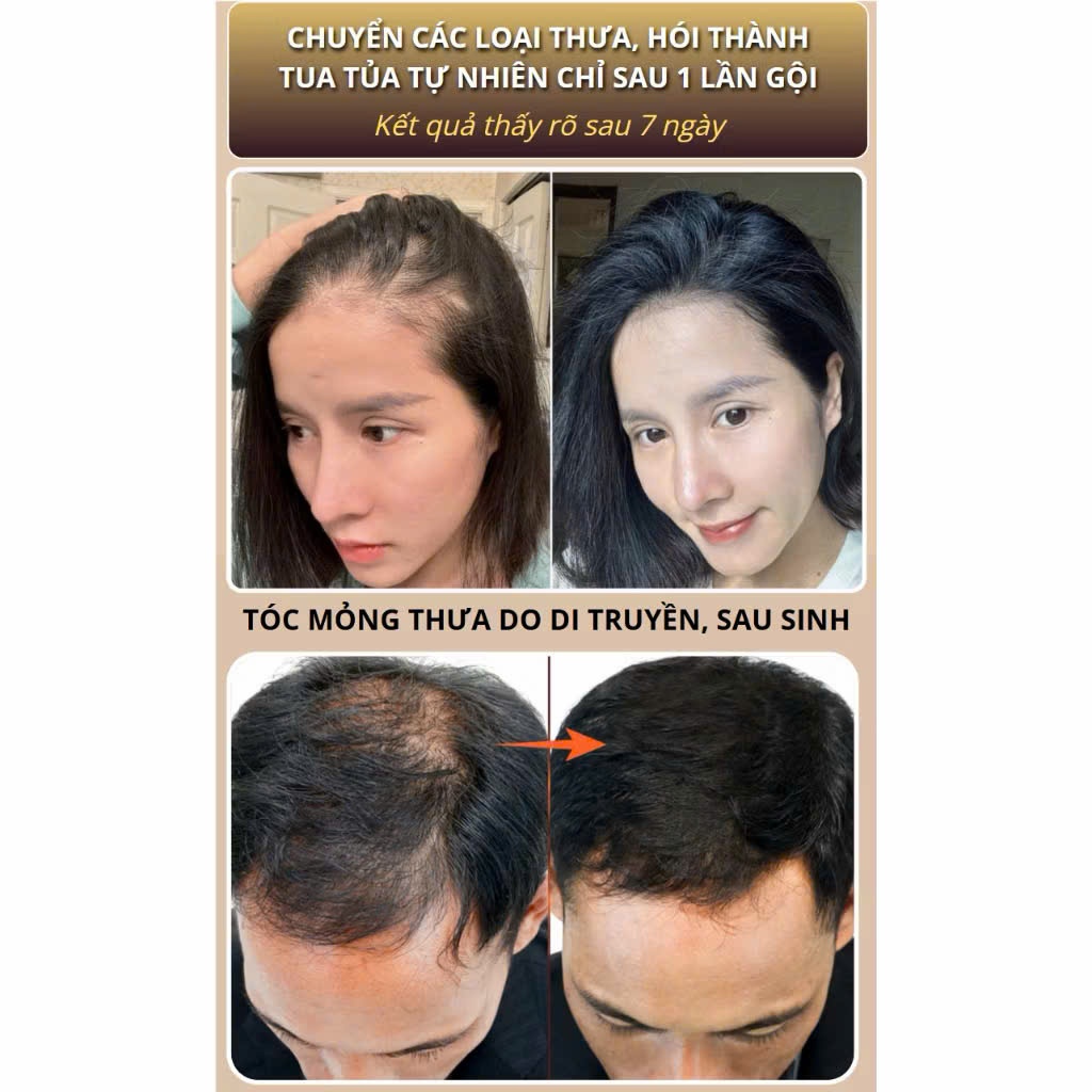 Dầu Gội Chiết Xuất Gừng Cao Cấp Kích Thích Mọc Tóc Ngăn Ngừa Tóc Gãy Rụng Giúp Mái Tóc Của Bạn Bồng Bềnh Mềm Mại