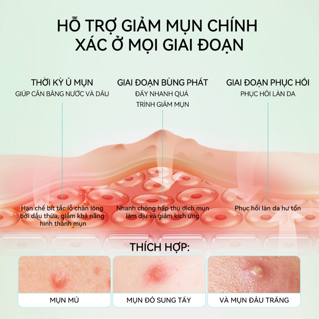 Miếng Dán Mụn Lanbena Invisible Acne Pimple Ban ngày và ban đêm
