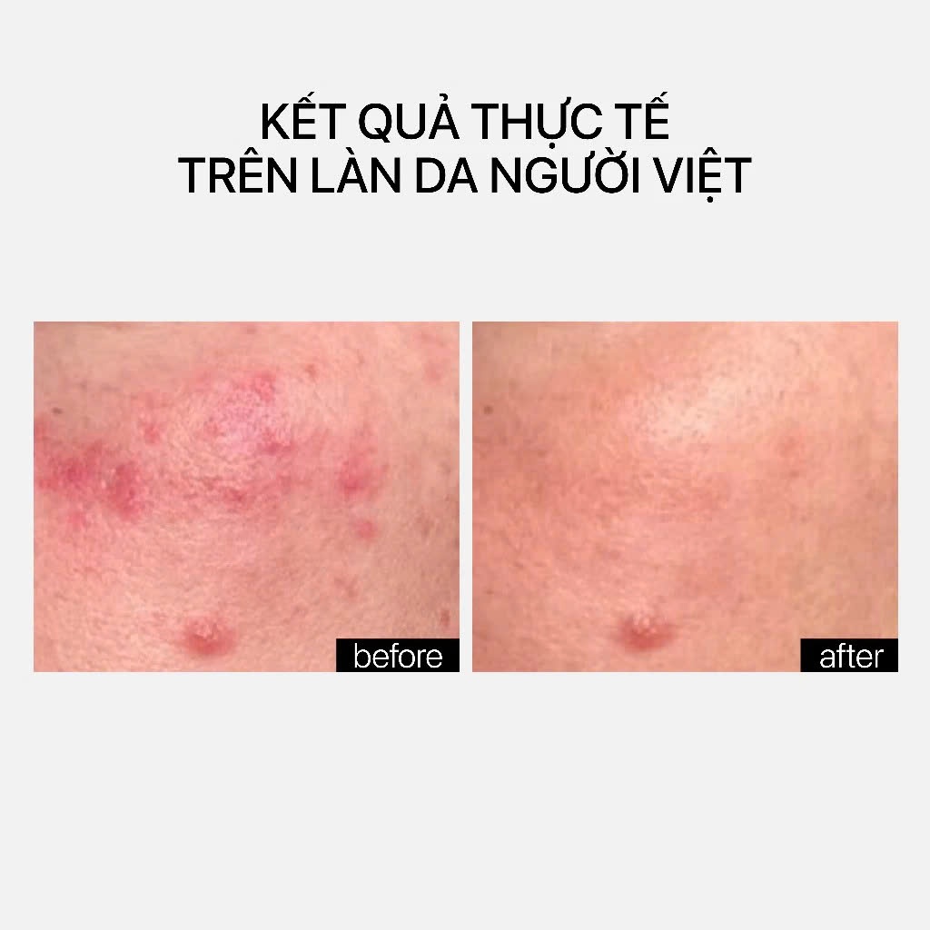 Serum Siêu Phục hồi, ngừa lão hóa, da sáng khỏe ẩm mịn THERAMID CERAMIDE TREATMENT 3% Ceramide Ectoine CICA 30ml