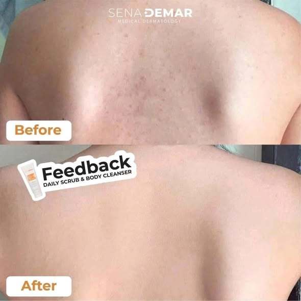 Tẩy Da Chết Body SenaDemar, Làm sạch, loại bỏ lớp sừng da chết và bã nhờn 200ml-Thylee