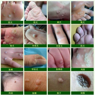 Kem Mụn Cóc Nhật Bản, Hỗ Trợ Làm Mềm Mụn Thịt Da Thừa Nốt Nhỏ Trên Da, Dễ Sử Dụng Tại Nhà An Toàn