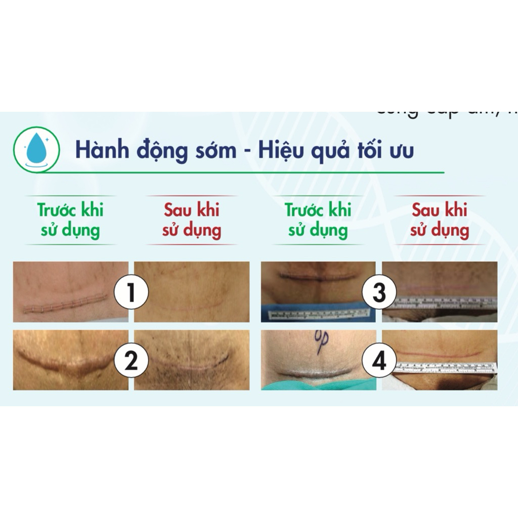 miếng dán ép sẹo sau sinh sau mổ Taicend miếng dán làm phẳng sẹo