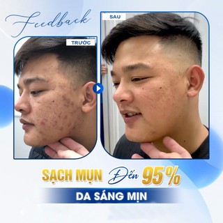 Gel Giảm Mụn Chấm Mụn Klena BPO Adapalene 0.1% and Benzoyl Peroxide 2.5% 30gram Phục Hồi Da Nhạy Cảm