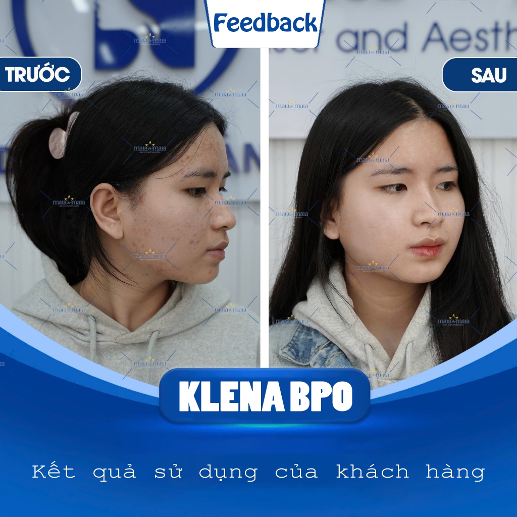 Giảm Mụn Klena BPO Adapalene 0.1% and Benzoyl Peroxide 2.5% 30gram giảm mụn ẩn mờ thâm, mụn trứng cá