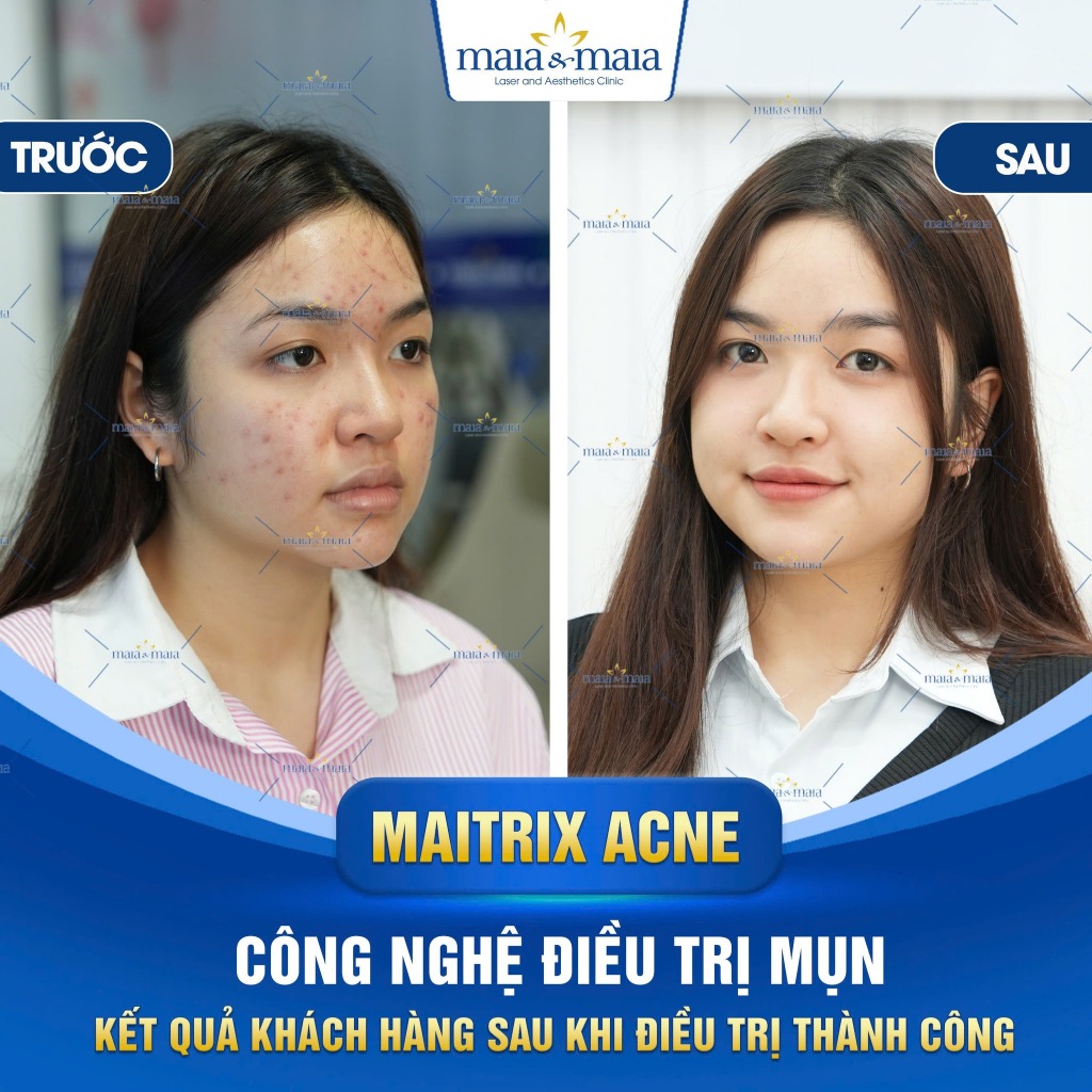 Gel Chấm mụn Klena BPO Adapalene 0.1% Benzoyl Giúp Phục hồi giảm mụn ẩn mờ thâm không gây khô da