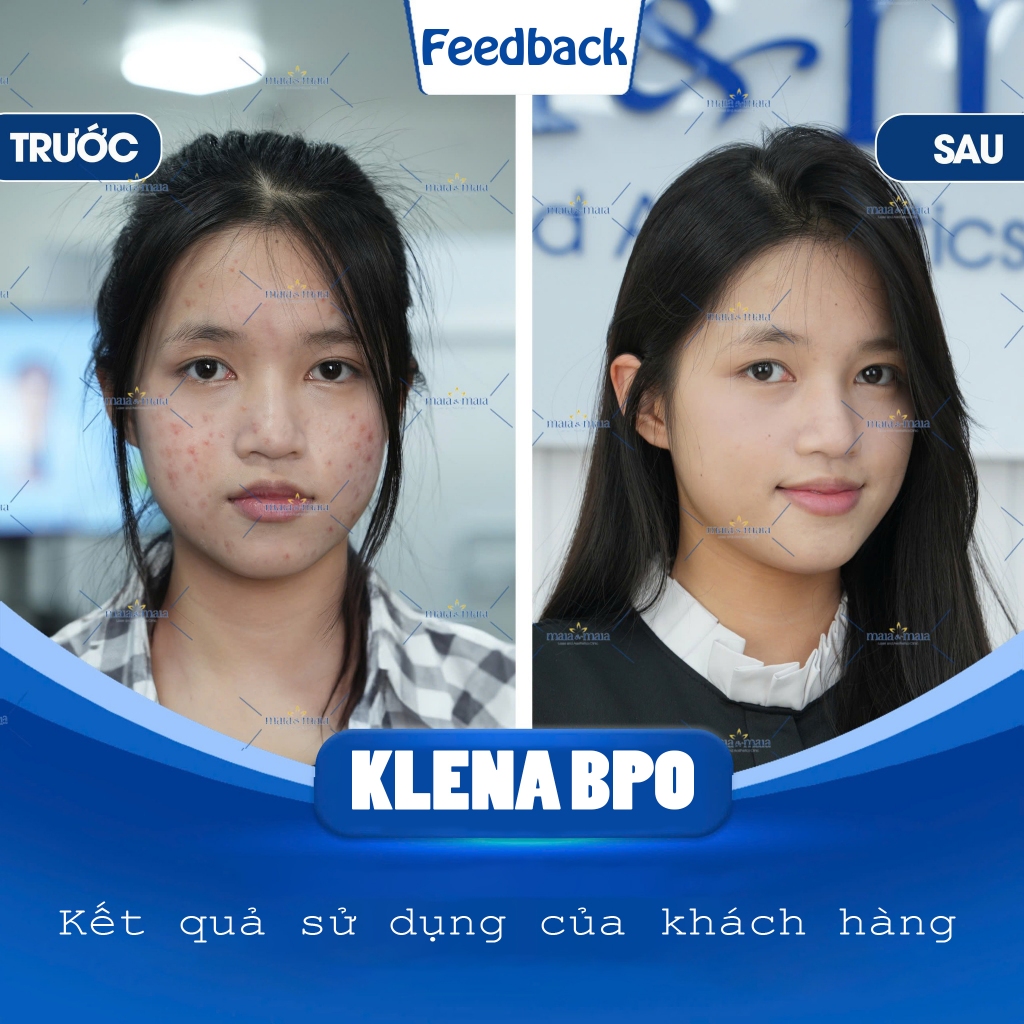 Gel Chấm mụn Klena BPO Adapalene 0.1% Benzoyl Giúp Phục hồi giảm mụn ẩn mờ thâm không gây khô da