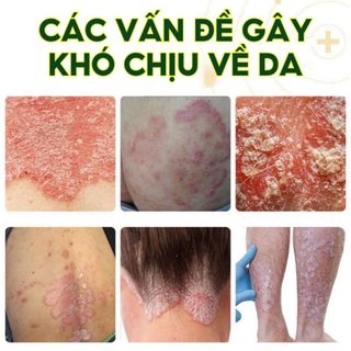 Homee.cok Kem Bôi Da Nhật Bản Hỗ Trợ Giảm Nấm Ngứa, Viêm Da, Hắc Lào, Ghẻ Nước – Dịu Da, Thấm Nhanh