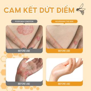 Homee.cok Kem Bôi Da Nhật Bản Hỗ Trợ Giảm Nấm Ngứa, Viêm Da, Hắc Lào, Ghẻ Nước – Dịu Da, Thấm Nhanh