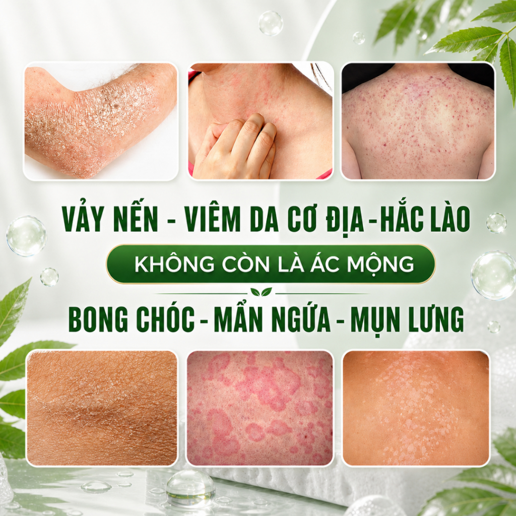 Xà Bông Thảo Mộc Giảm Vảy Nến, Viêm Da Cơ Địa, Hắc Lào, Ngứa Đỏ - Soritox 100Gr [XBT]