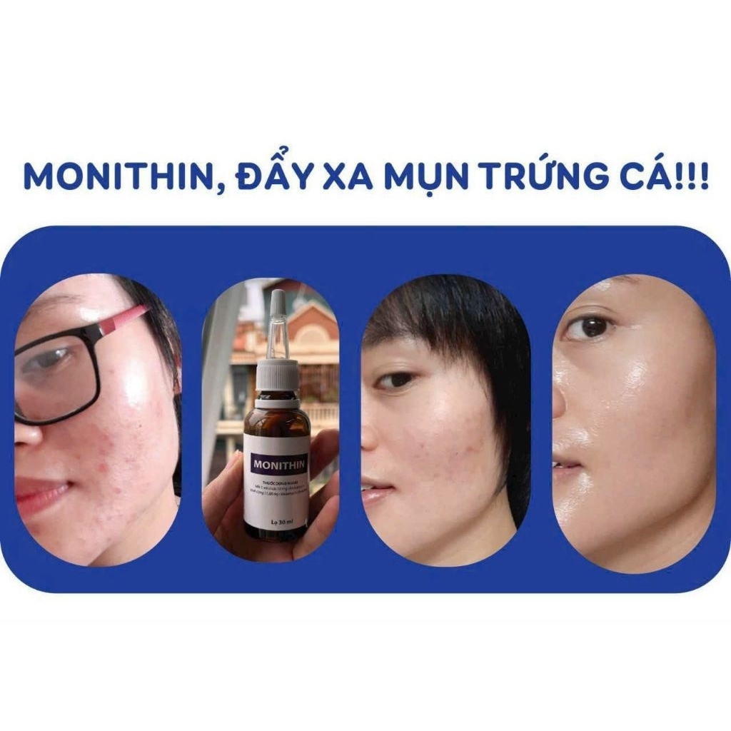 Serum chấm mụn MONlTHlN thấm nhanh - GIAO HÀNG NHANH