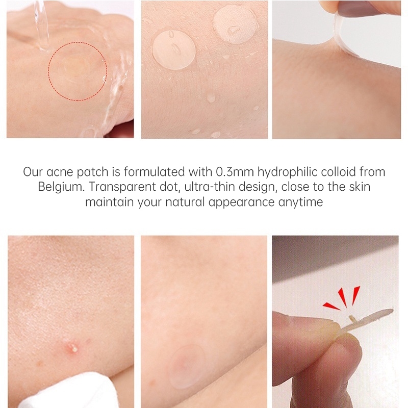 🍓Miếng dán Hỗ trợ giảm mụn Star Hydrocolloid để che vết thâm và vết thâm, Miếng dán vết thâm vô hình, Miếng dán vết thâm