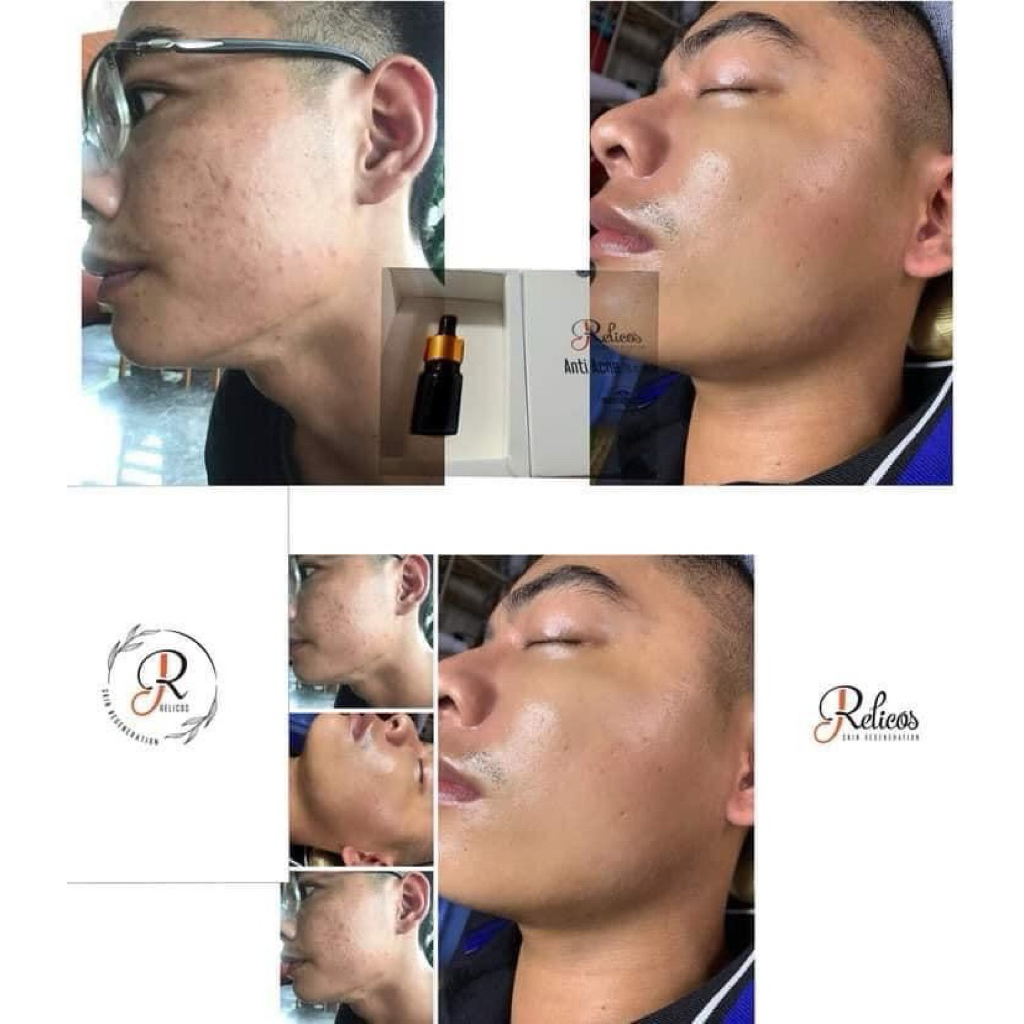 Serum sạch mụn Relicos loại trừ mụn tận gốc (date mới nhất 2028 chính hãng cty)