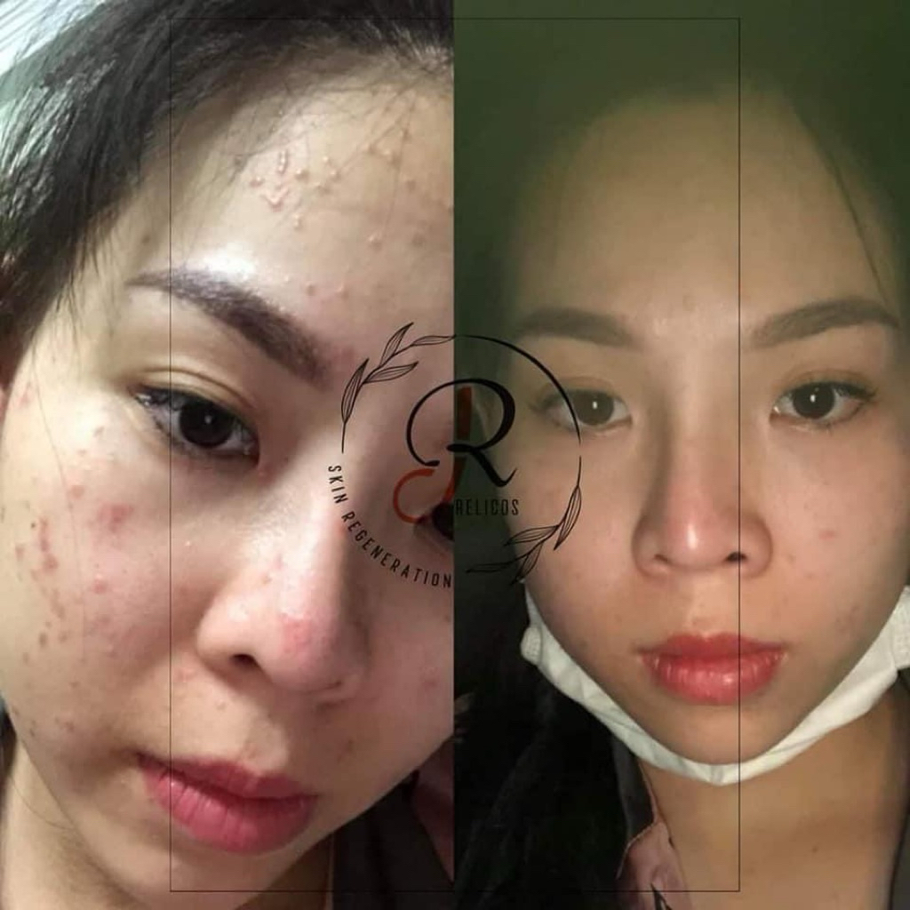 Serum sạch mụn Relicos loại trừ mụn tận gốc (date mới nhất 2028 chính hãng cty)