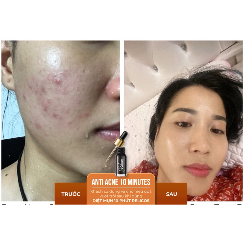 Serum sạch mụn Relicos loại trừ mụn tận gốc (date mới nhất 2028 chính hãng cty)