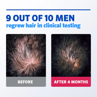 Tinh chất mọc tóc cho nam Men's Rogaine 5% Minoxidil Solution 60ml/Foam Hair Regrowth Treatment 60ml