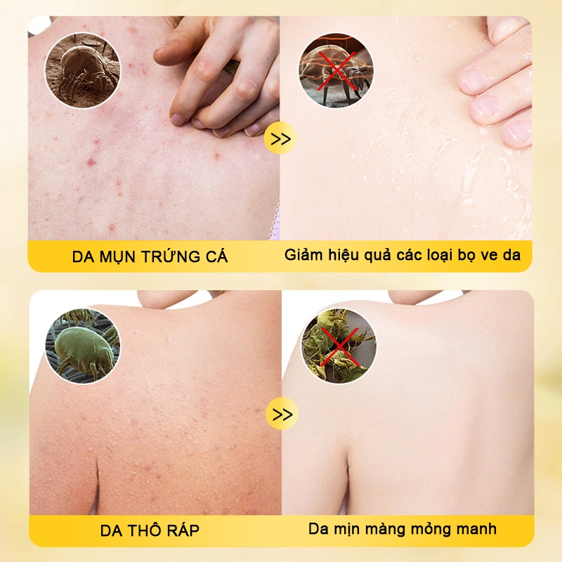 Sữa tắm lưu huỳnh LYDIMOON Sữa tắm viêm nang lông Kháng Khuẩn Da Và Giảm Mụn Lưng Mờ Thâm, Làn Da Sạch Mịn 500ML
