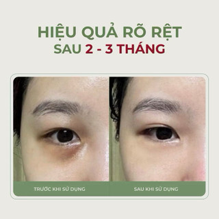 Kem mắt Abera chuyên quầng thâm, bọng mắt và nếp nhăn