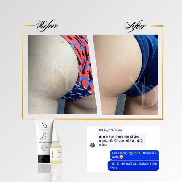COMBO Giảm Mụn, Giảm Thâm Face & Body Bha Serum 8% ND 15ml và Be Charm Cream 100ml