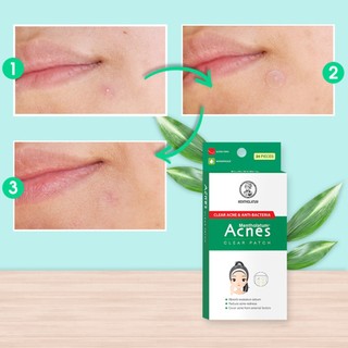 Miếng Dán Mụn Acnes Clear Patch Giúp Giảm Mụn Sưng 24 Miếng