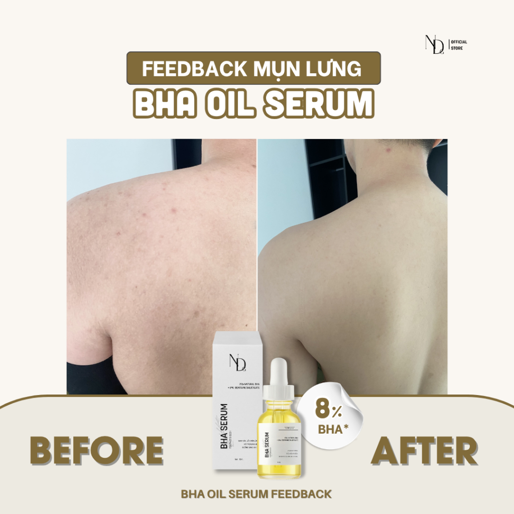 Tinh chất giảm mụn lưng, mụn mông, tẩy tế bào chết hóa học BHA SERUM ND 8% 15ml
