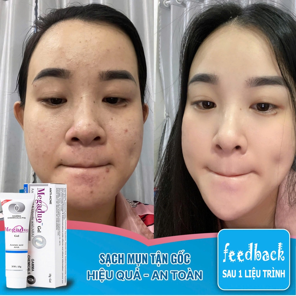 Chấm mụn mờ thâm Megaduo Anti‑Acne Gel 15g – Gel dưỡng giảm mụn, làm mờ thâm