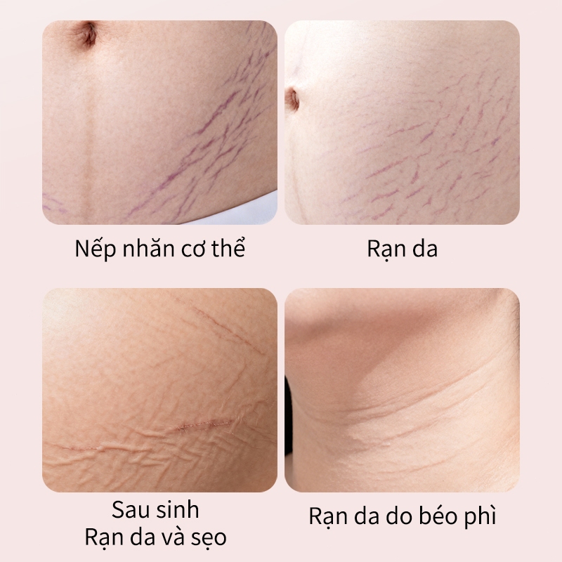 kem rạn da cho bà bầu 120g chiết xuất thiên nhiên bơ hạt mỡ dầu dừa giảm thâm mờ sẹo phục hồi da chống rạn hiệu quả