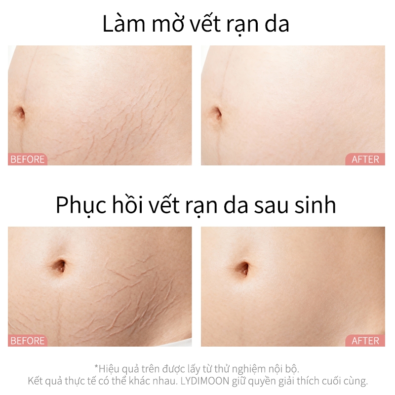 kem rạn da cho bà bầu 120g chiết xuất thiên nhiên bơ hạt mỡ dầu dừa giảm thâm mờ sẹo phục hồi da chống rạn hiệu quả