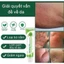 Kem bôi da XÀ SÀNG TỬ kháng khuẩn, kháng nấm và giảm ngứa Vẩy nến, vẩy cá, vẩy sừng...