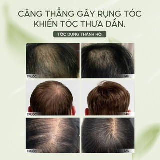 Xịt Mọc Tóc Lab On Hair 160ml - Giấm Táo Kích Thích Mọc Tóc, Giảm Rụng Tóc Hiệu Quả, Củng Cố Chân Tóc Cho Tóc Mọc Chậm