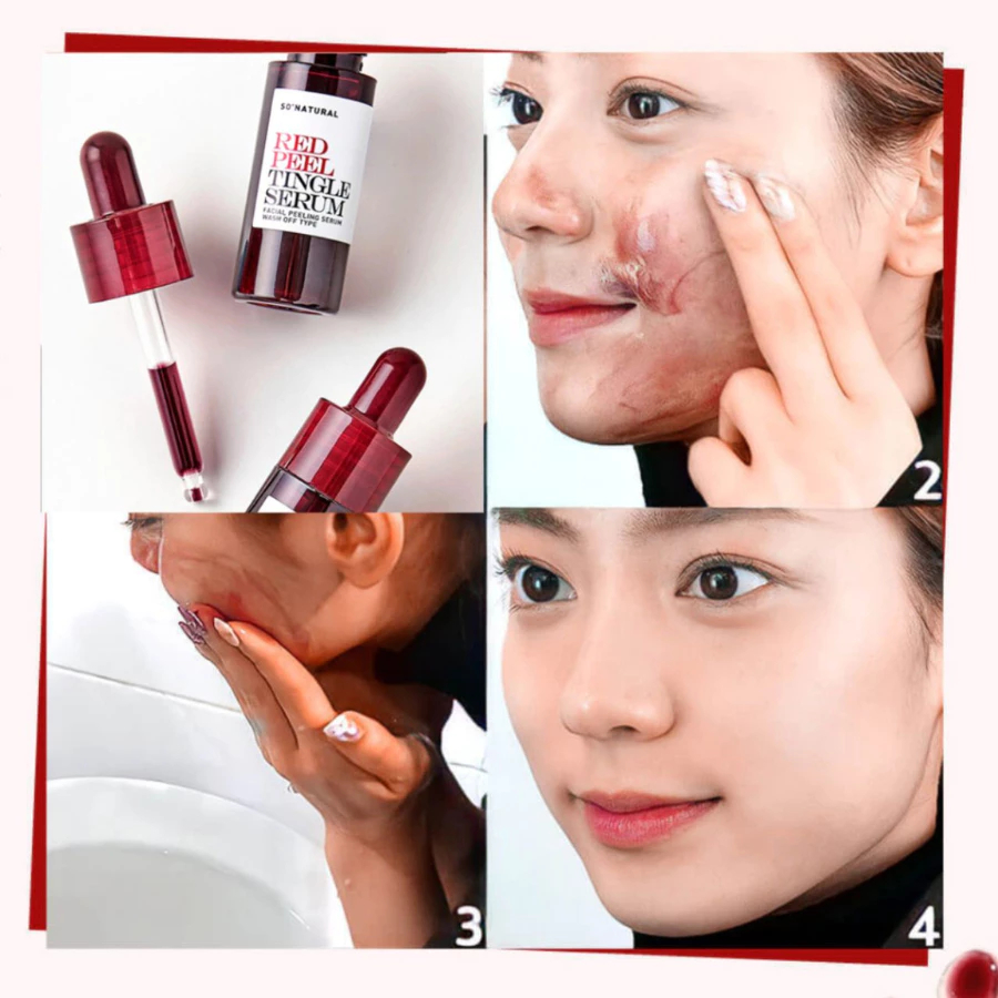 Tinh Chất Red Peel Tingle So Natural Giảm Thâm Và Làm Trắng Da - Ever Queen