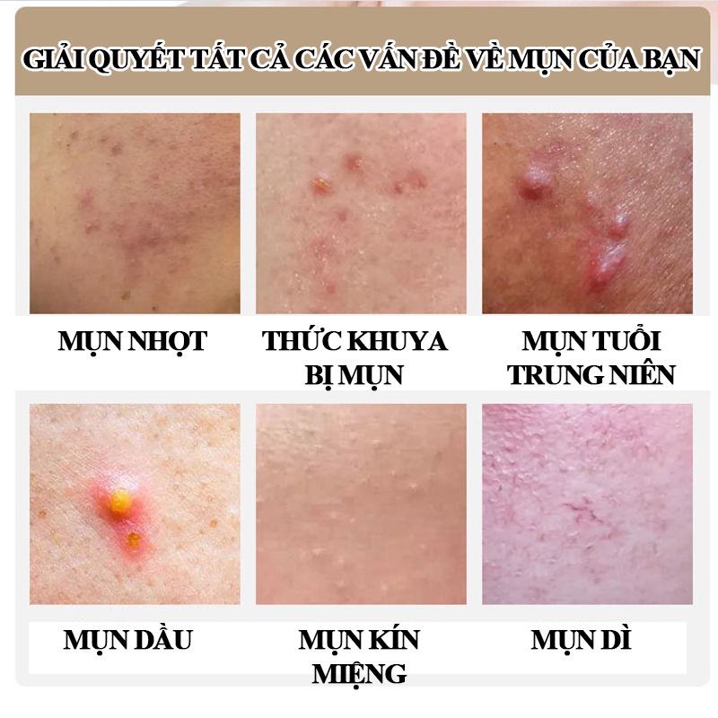 kem chấm mụn Gel giảm mụn, chóng loại bỏ mụn bọc,giảm thâm ngăn mụn tái phát, kem bôi mụn làm mờ thâm mụn