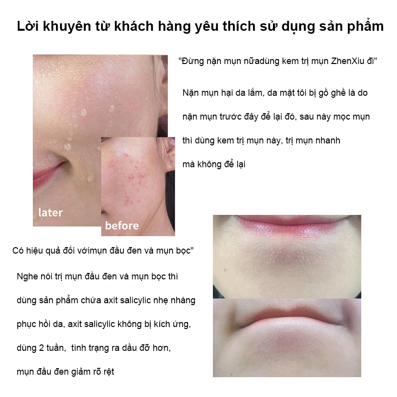 kem chấm mụn Gel giảm mụn, chóng loại bỏ mụn bọc,giảm thâm ngăn mụn tái phát, kem bôi mụn làm mờ thâm mụn