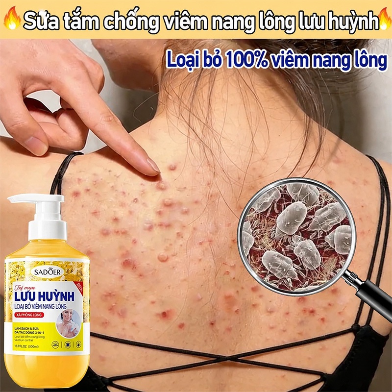 Sữa tắm lưu huỳnh SADOER Sữa tắm viêm nang lông Kháng Khuẩn Da Và Giảm Mụn Lưng Mờ Thâm, Làn Da Sạch Mịn 500ML