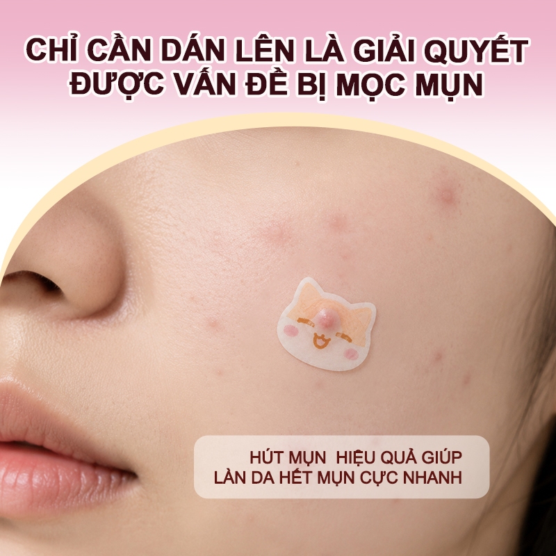Miếng dán mụn HEXZE hình mèo dễ thương hỗ trợ kháng khuẩn, lành mụn nhanh