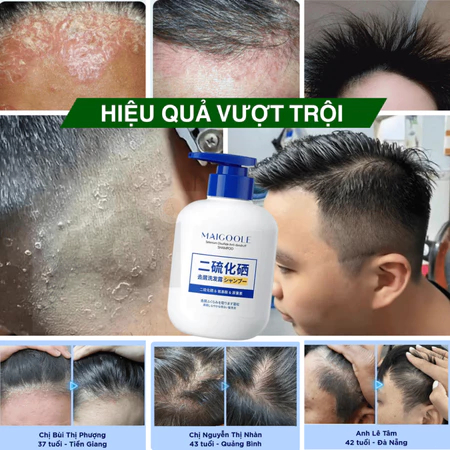 dầu gội diệt chấy dầu gội sạch gàu 300ml giảm ngứa nhanh chóng làm sạch sâu da đầu diệt bọ ve