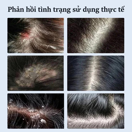 dầu gội diệt chấy dầu gội sạch gàu 300ml giảm ngứa nhanh chóng làm sạch sâu da đầu diệt bọ ve