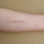 Miếng dán sẹo silicone gel (Silicone Gel Sheet) của hãng Wanhe dùng để hỗ trợ loại bỏ sẹo.