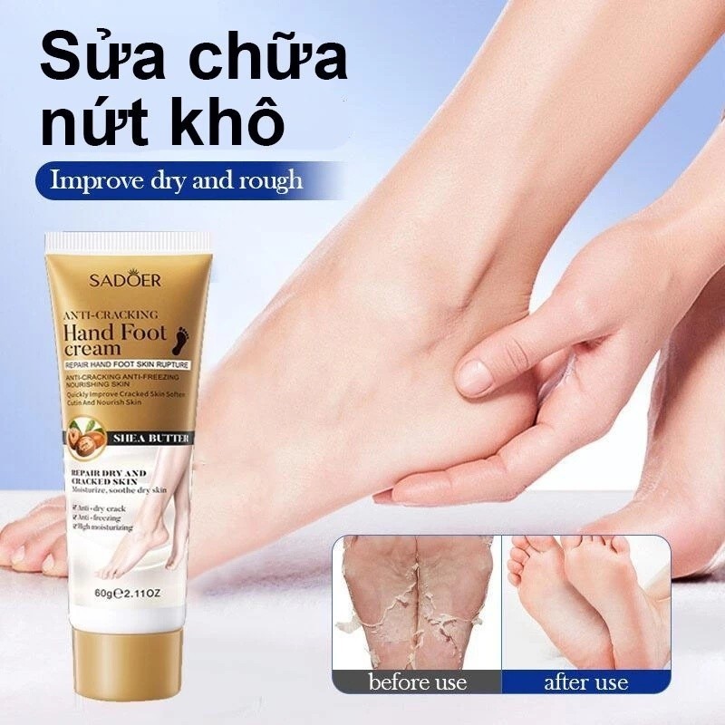 Kem dưỡng gót chân nứt nẻ chai sần– Dưỡng ẩm sâu phục hồi da chân khô ráp giảm nứt nẻ và chai cứng (60g)