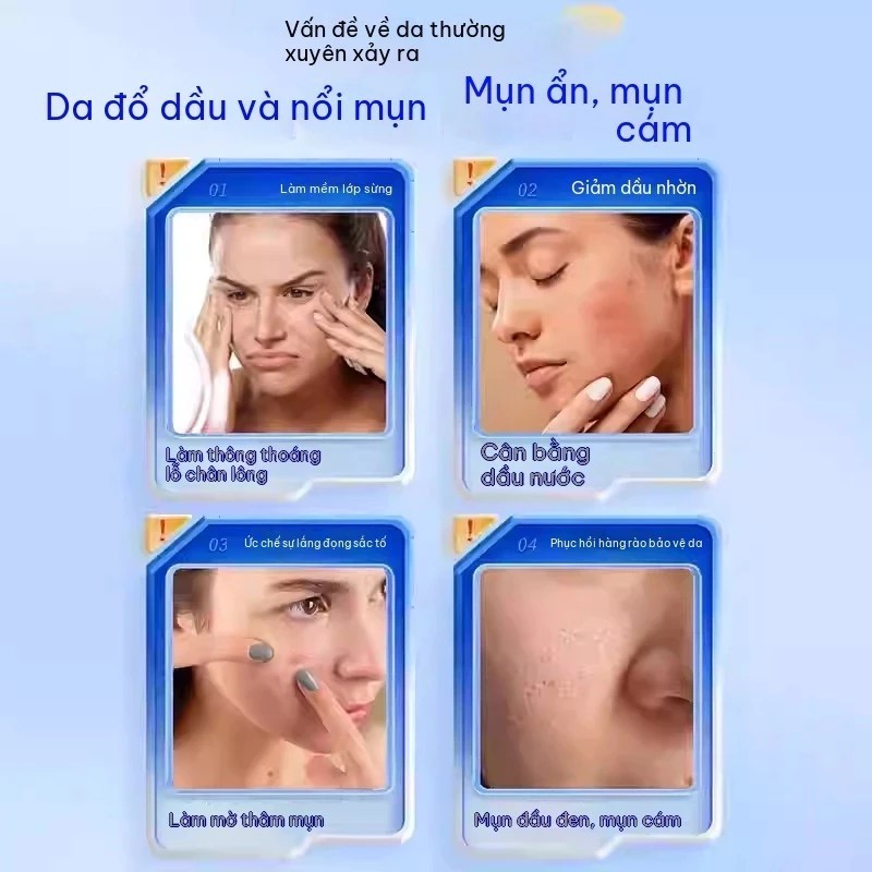 Kem Finacea 15% Axit Azelaic (30g): hỗ trợ cải thiện mụn, mụn ẩn, da đỏ và vết thâm sau mụn